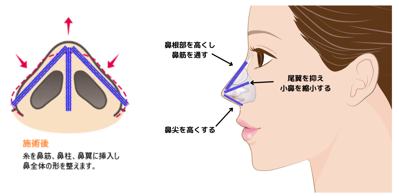 Gコグノーズ