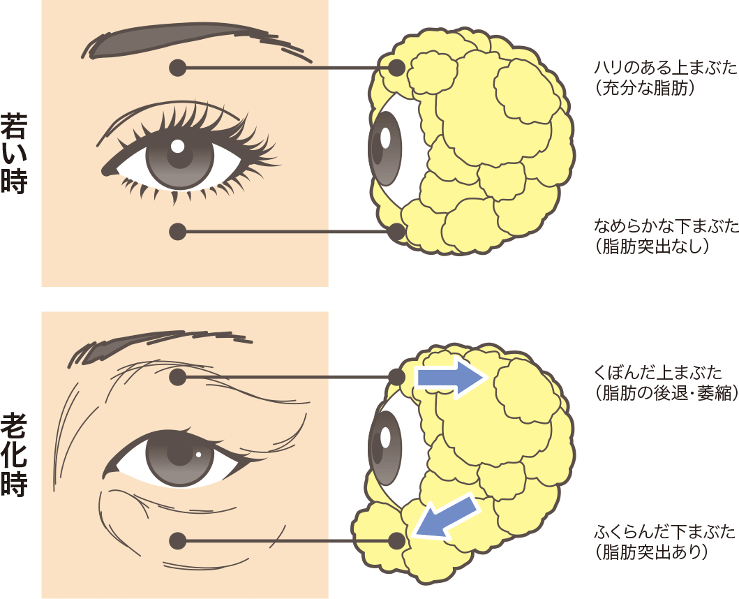 二重埋没法 二重全切開法で目の下や目頭 まぶたのたるみを除去 静岡美容外科橋本クリニック