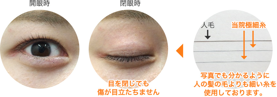 二重まぶた埋没法の極細専用手術糸