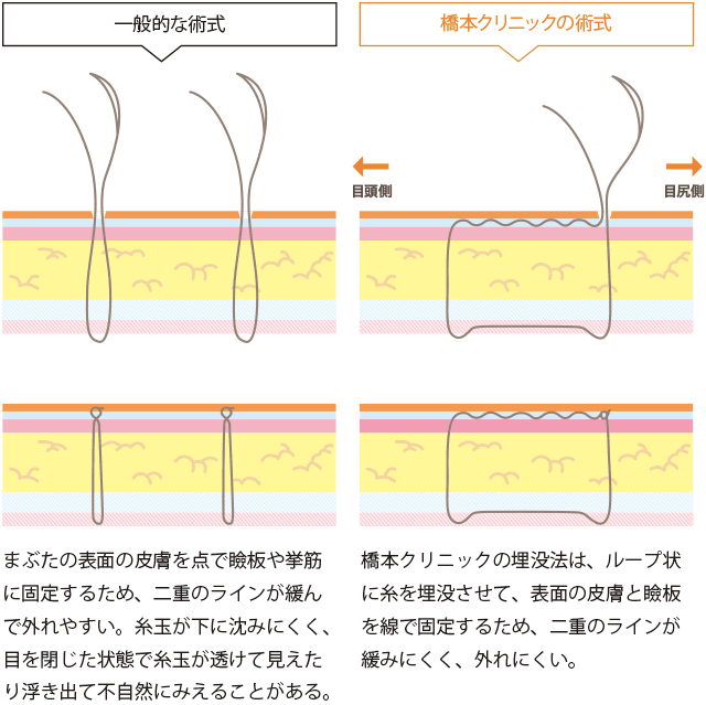 二重まぶた埋没法の術式