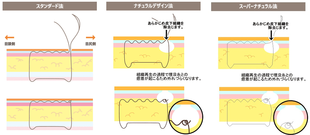 二重まぶた埋没法の術式