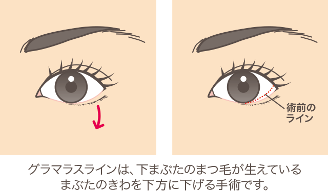 グラマラスライン(たれ目形成)