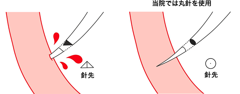 埋没法で使用する針