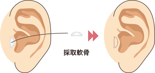 鼻尖形成（耳珠軟骨の移植）