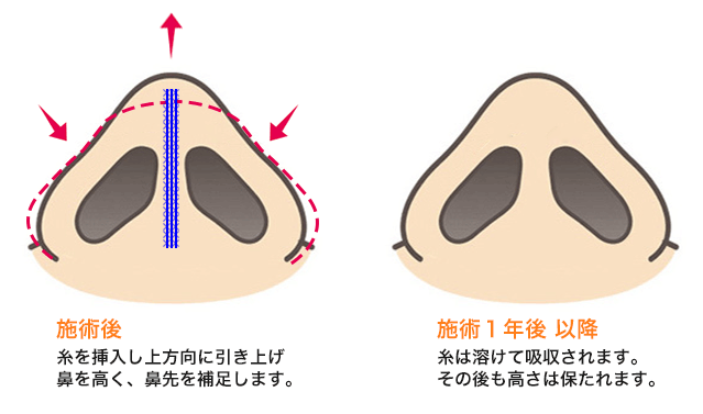 プチ鼻尖形成(ノーズリフト)の施術
