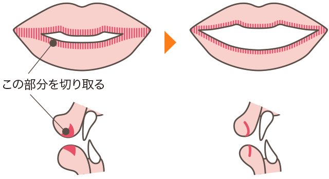 上下の唇を薄くする整形