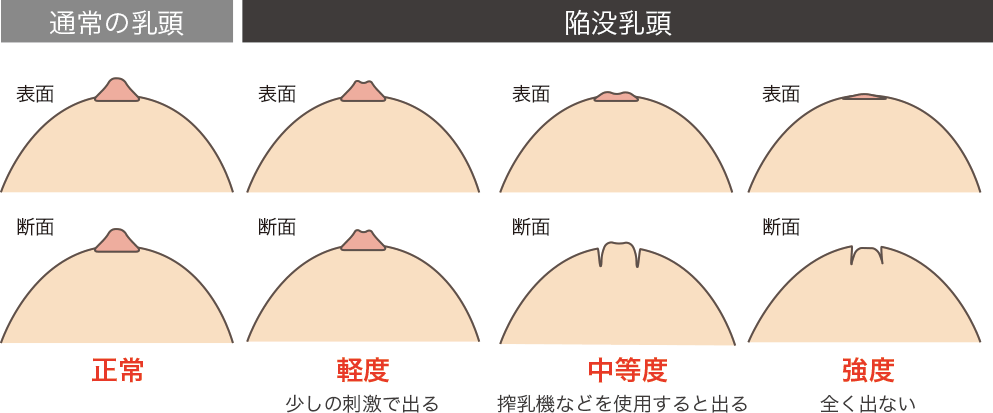 陥没 ちくび と は