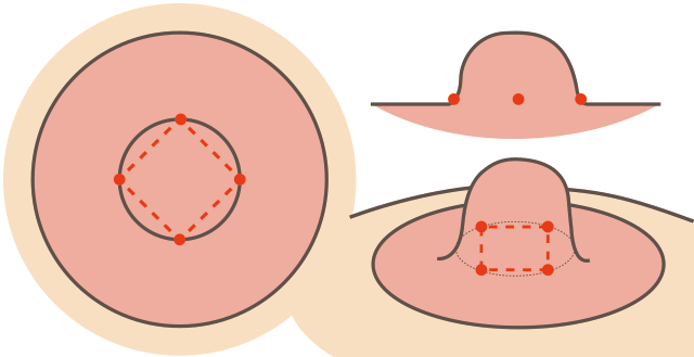 切らない陥没乳頭