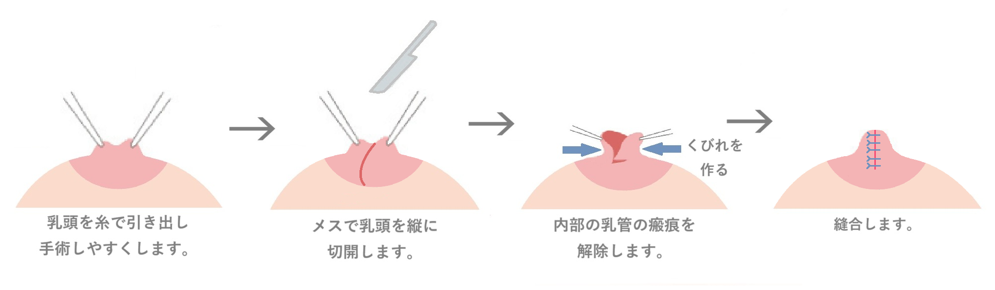 陥没乳頭