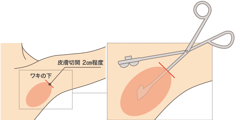 イナバ式組織削除法