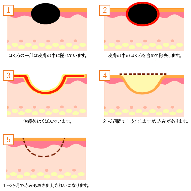 ほくろ いぼ うおのめ 傷跡修正 ストレッチマーク治療 診療内容 料金 静岡美容外科橋本クリニック