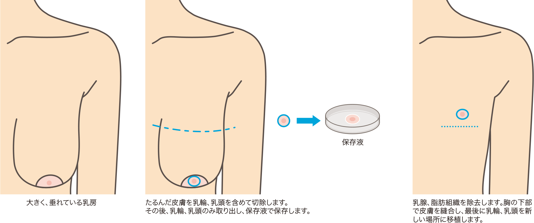 乳腺切除 睾丸摘出などのｇｉｄ 性転換手術 静岡美容外科橋本クリニック