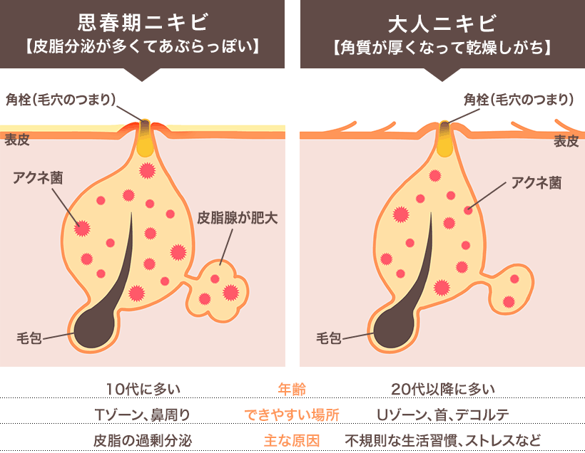 思春期ニキビと大人ニキビの違い