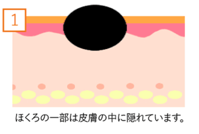ほくろの一部は皮膚の中に隠れています。