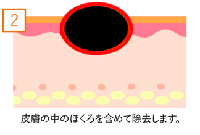 皮膚の中のホクロを含めて除去します。