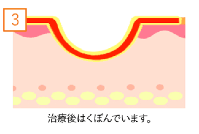 治療後はくぼんでいます。