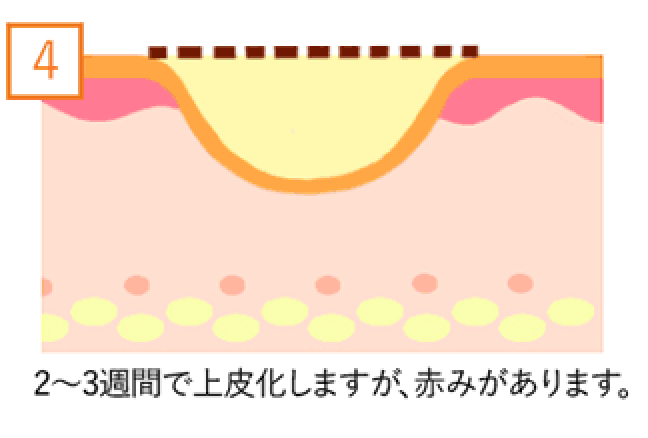 2〜3週間で上皮化しますが、赤みがあります。