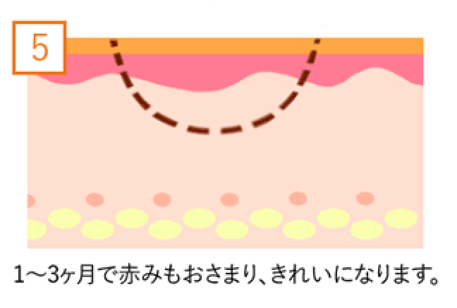 1〜3ヶ月で赤みもおさまり、きれいになります。