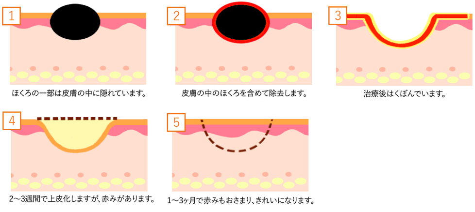 電気凝固法（高周波レーザー）の方法