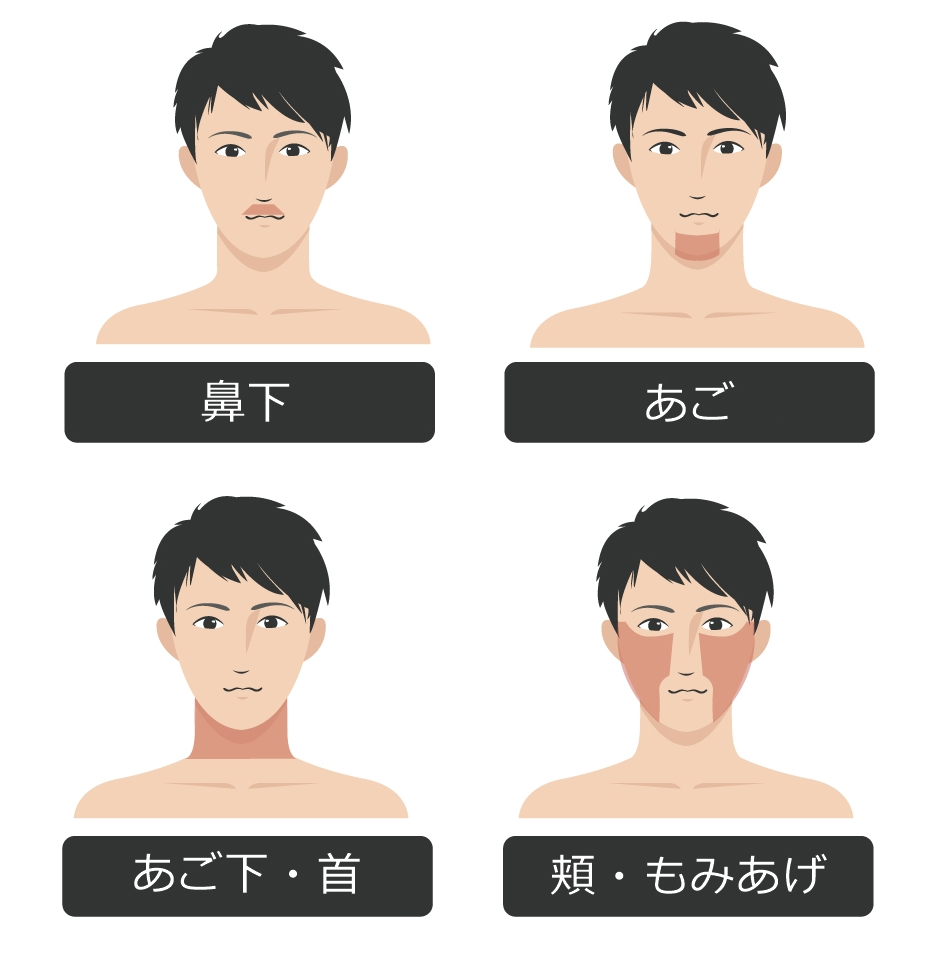 メンズひげ脱毛 脱毛範囲